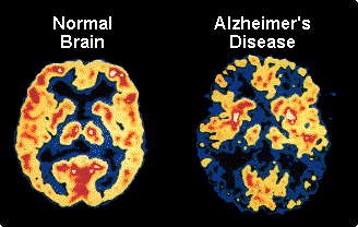 Alzheimer disease